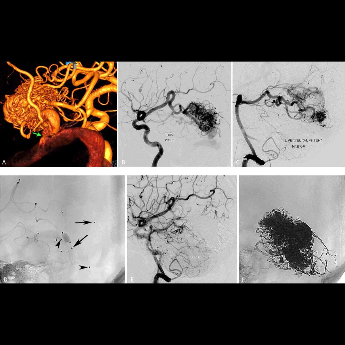 Saatci et al. summarizes published embolization results and the latest curative advanced embolization techniques in the endovascular management of bAVMs in this excellent review! #AVM #endovascular #neurointervention bit.ly/4a0oa6a