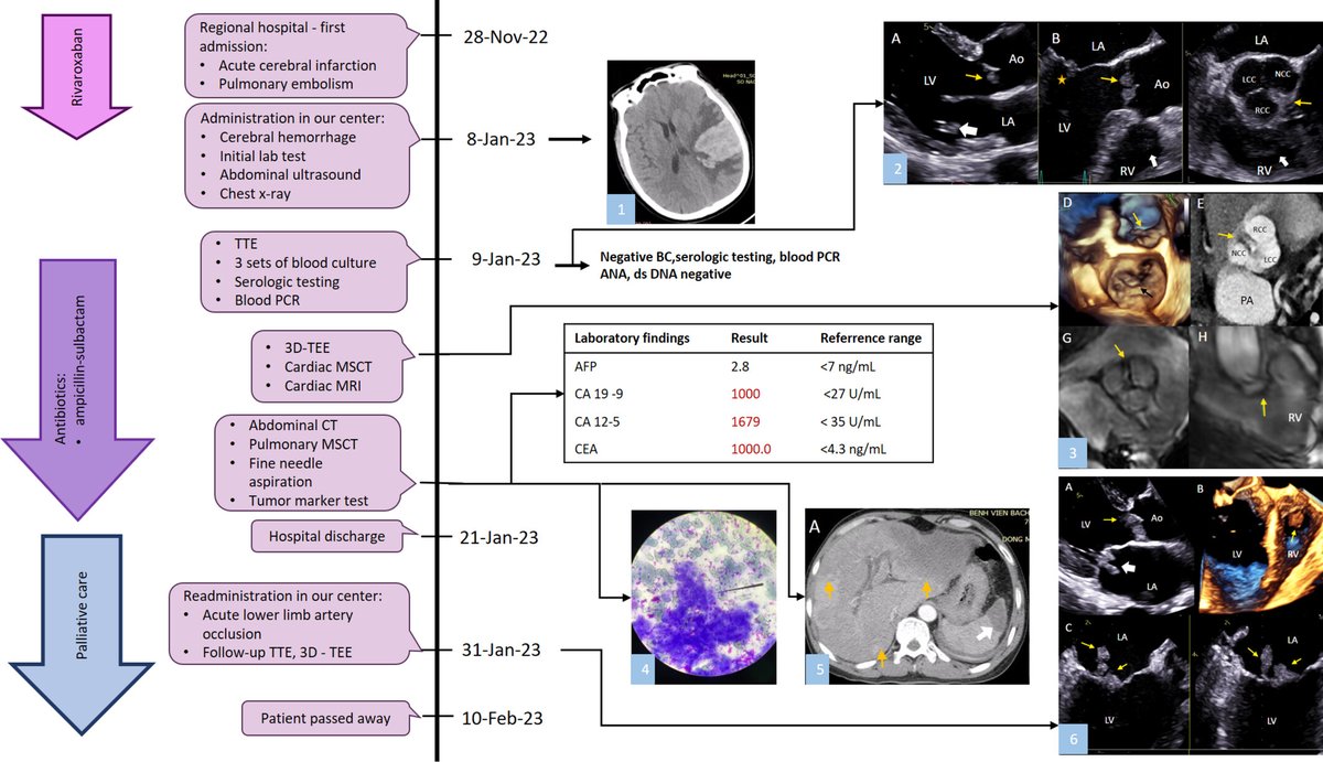 Wiley_CancerRep's tweet photo. Nguyen et al. describe a case of patient with multiple heart lesions due to systemic effect of #cholangiocarcinoma.
https://t.co/eXhcxj1vQb
#CancerReports #Wiley #CaseReport #NonbacterialThromboticEndocarditis #MultimodalityImaging #Echocardiography
@WileyBiomedical @WileyOnc_Hem https://t.co/58DnBKN41y