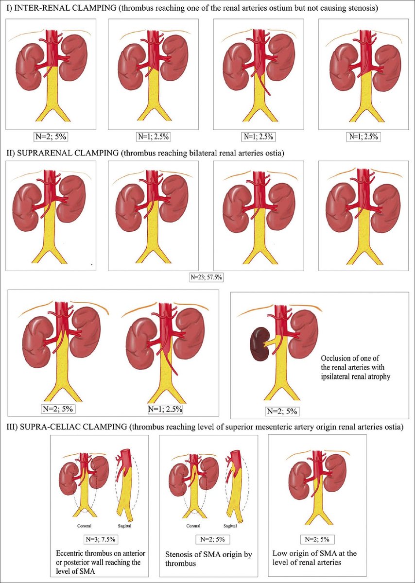 VSI journal IJVES (@vsijournalijves) on Twitter photo 🎇"Wrapping 2024 with an engaging read for #AortaEd enthusiasts! 🚀 Dive into this new classification system for Juxtarenal aortic occlusion
journals.lww.com/ijvs/fulltext/… <a href="/pcvasc/">P C Gupta</a>
<a href="/SavlaniaAjay/">Ajay Savlania</a> <a href="/VarenyamVasc/">Dr Himanshu Verma</a>
<a href="/PShivanesandr/">DrPShivanesan</a> <a href="/farkomd/">frank arko</a> <a href="/RMotaganahalli/">Raghu Motaganahalli</a> <a href="/XavierBerardMD/">Xavier Berard</a> <a href="/docpark/">W. Michael Park, MD</a> <a href="/jmills1955/">Joseph L. Mills MD</a> 🎇"Wrapping 2024 with an engaging read for #AortaEd enthusiasts! 🚀 Dive into this new classification system for Juxtarenal aortic occlusion
journals.lww.com/ijvs/fulltext/… <a href="/pcvasc/">P C Gupta</a>
<a href="/SavlaniaAjay/">Ajay Savlania</a> <a href="/VarenyamVasc/">Dr Himanshu Verma</a>
<a href="/PShivanesandr/">DrPShivanesan</a> <a href="/farkomd/">frank arko</a> <a href="/RMotaganahalli/">Raghu Motaganahalli</a> <a href="/XavierBerardMD/">Xavier Berard</a> <a href="/docpark/">W. Michael Park, MD</a> <a href="/jmills1955/">Joseph L. Mills MD</a>