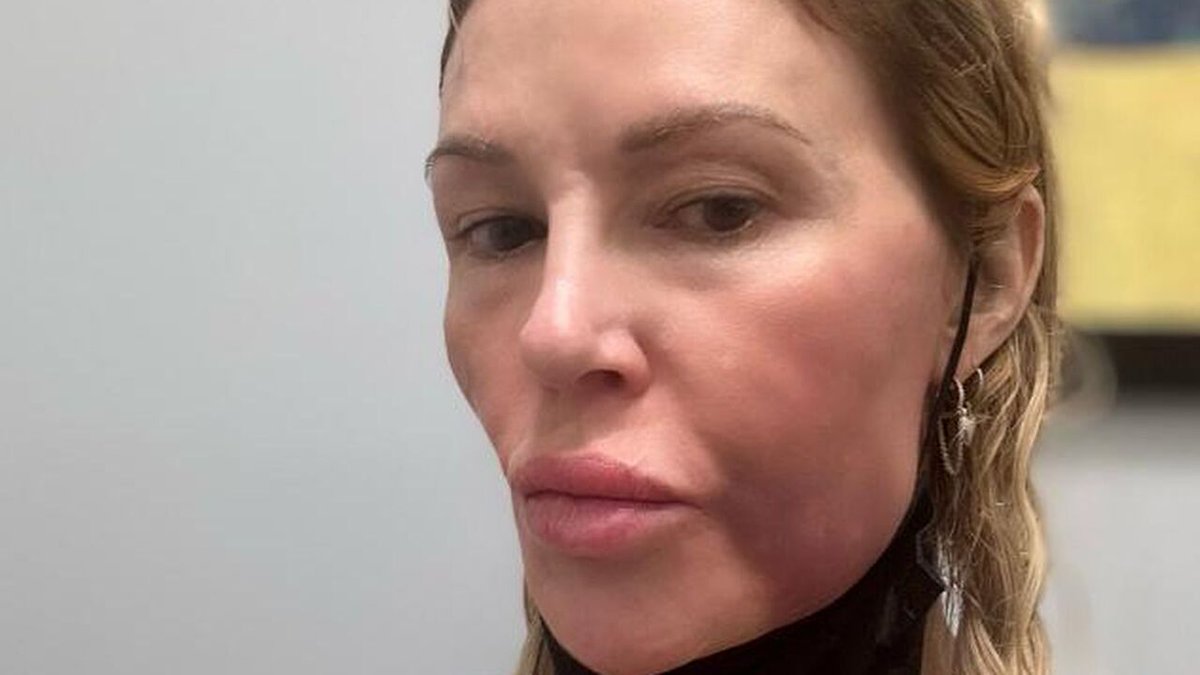 Brandi Glanvilles Gesichtsschwellung belastet ihr Liebesleben und bleibt unklar

Brandi Glanville, bekannt aus "Real Housewives of Beverly Hills", kämpft seit über einem Jahr mit einer unklaren Erkrankung, die ihr Gesicht verändert hat. Trotz Ausgaben vo… aktuellmagazin.de/brandi-glanvil…