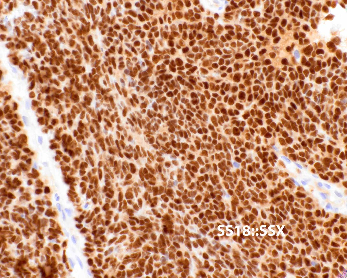 Poorly differentiated synovial sarcoma is an easy diagnosis with modern immunohistochemistry!