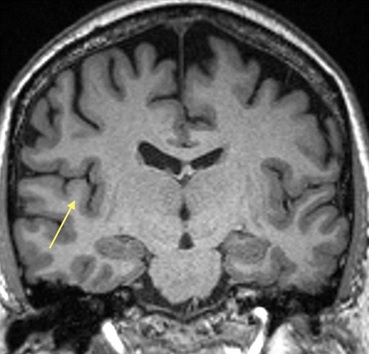 daniel_gewolb's tweet photo. Heschl’s gyrus contains the primary auditory cortex (Broadmann areas 41 &amp; 42)

💡 Hints to find it:
▶️Arises just posterior to the insular cortex on axial
▶️Look within the Sylvian fissure on coronal
▶️Runs inferior to the post central gyrus on sagittal

#Neurology #radres #ENT https://t.co/76SJn9WUgs