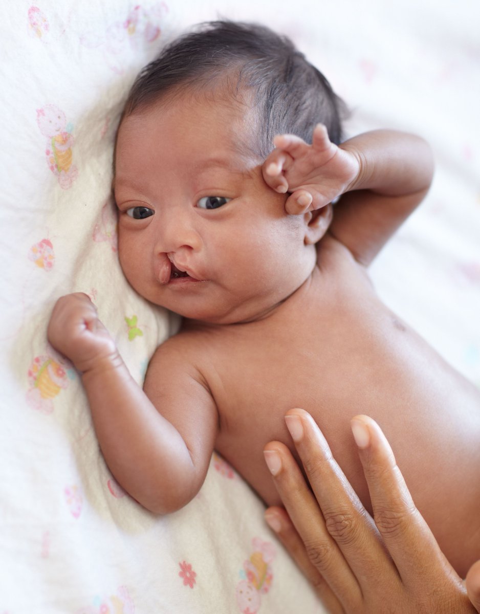 CRANE (@crane_news) on Twitter photo π’ The 2024 Patient and Parent/Carer Summary of our ANNUAL REPORT is live to download!
π crane-database.org.uk/reports/crane-β¦
Thank you to the families who allow cleft services to collect and submit data to the CRANE Database!
π Find out more buff.ly/3B0rwZM
<a href="/CLAPACOMMUNITY/">Cleft Lip and Palate Association</a> π’ The 2024 Patient and Parent/Carer Summary of our ANNUAL REPORT is live to download!
π crane-database.org.uk/reports/crane-β¦
Thank you to the families who allow cleft services to collect and submit data to the CRANE Database!
π Find out more buff.ly/3B0rwZM
<a href="/CLAPACOMMUNITY/">Cleft Lip and Palate Association</a>