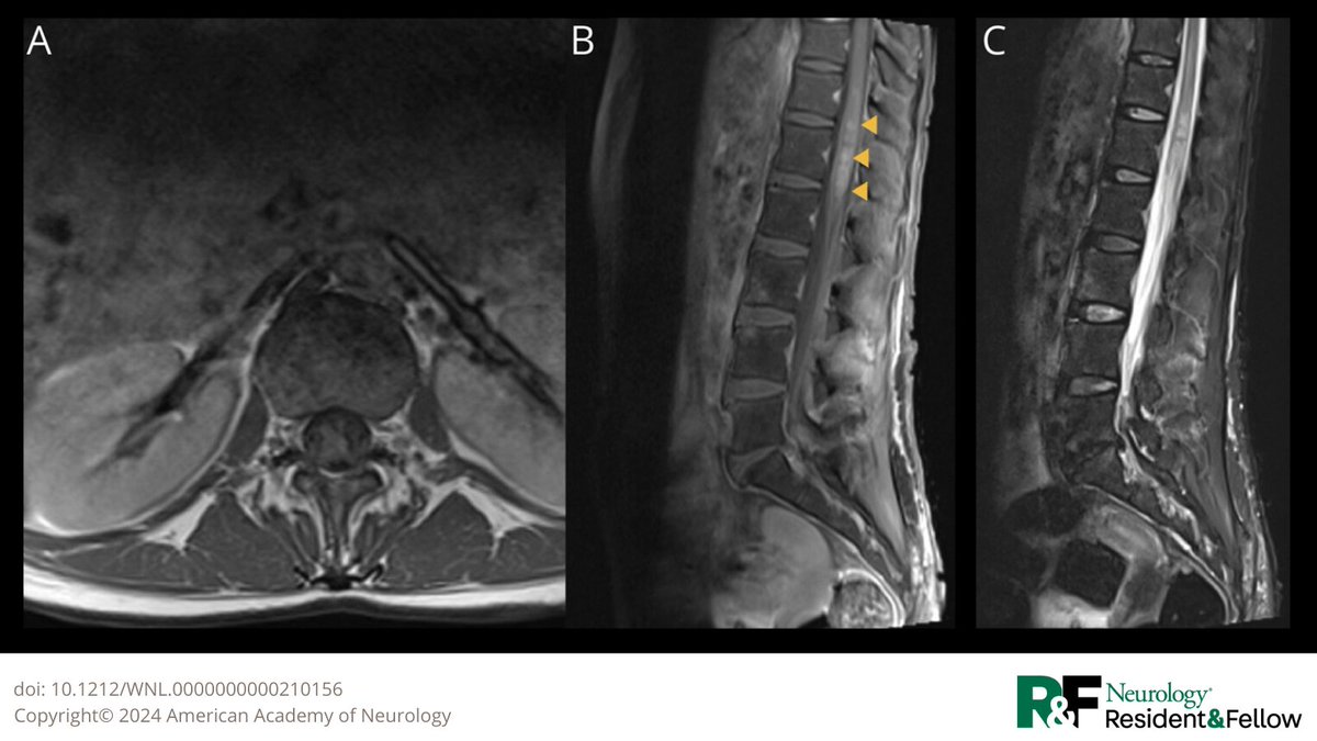 Teaching NeuroImage: Schistosomiasis Involving the Conus Medullaris bit.ly/3ZKTEZd

#NeurologyRF