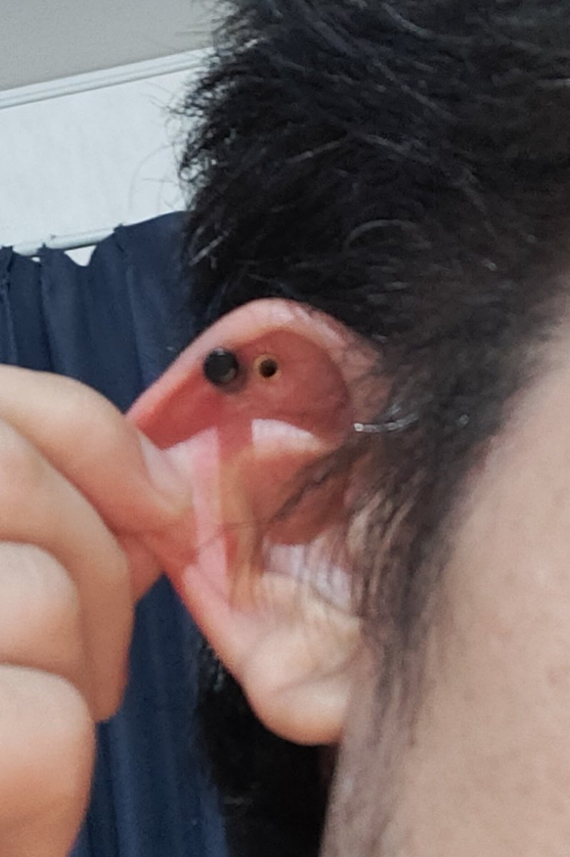 左　8→6G拡張中　クソ痛い
右　8G安定

ダブルフレアだから、実質8→4Gは無理ありずきた

#軟骨拡張
#ピアス好きと繋がりたい