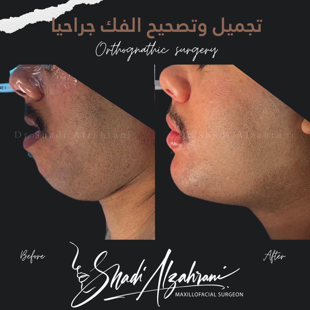 عملية الفك التقويمية لا تهدف فقط لتحسين الوظيفة مثل النطق والمضغ، بل تسهم أيضاً في تعزيز ثقتك بمظهرك وتنسيق ملامحك.