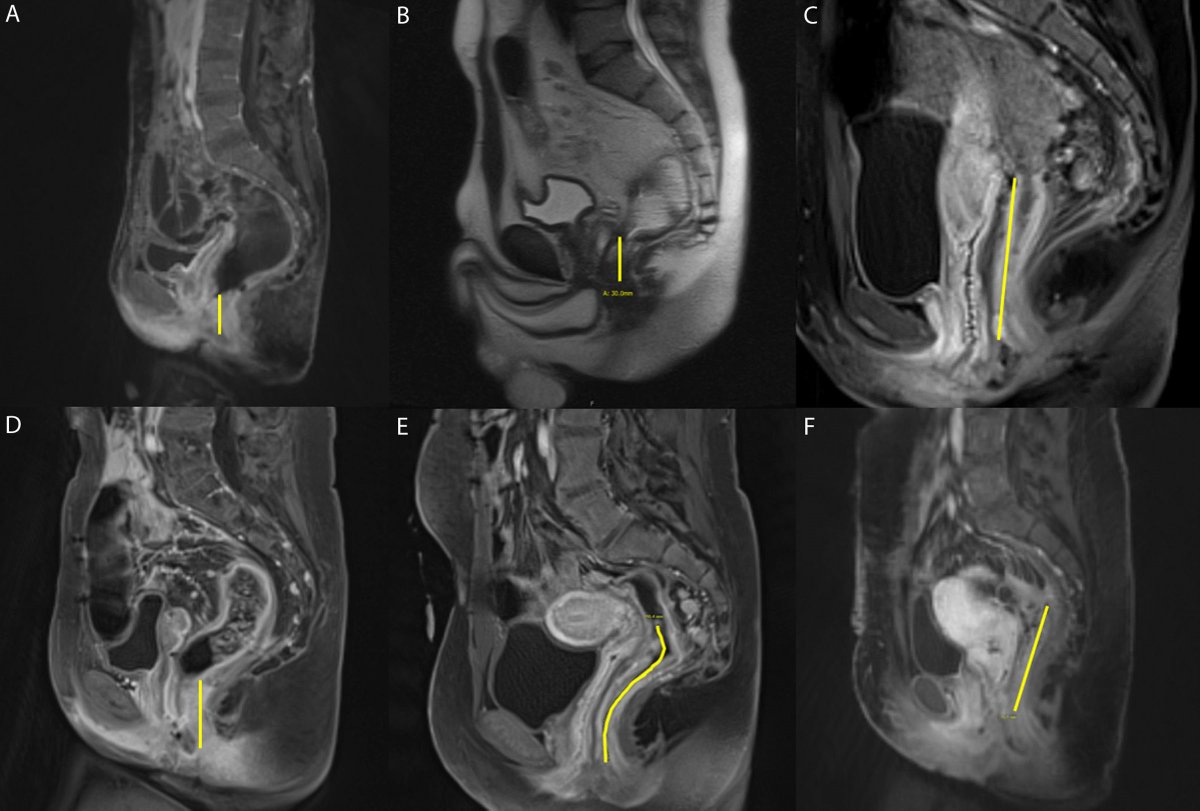 DCRjournal (@dcrjournal) on Twitter photo Large series of redo-IPAA due to long rectal cuff and/or remnant mesorectum. Read more in this month's #DCRJournal: bit.ly/49Kgncz
<a href="/MehmetGulmezMD/">Mehmet Gulmez, MD</a> @ErenEsenMD <a href="/MichaelJGrieco/">m</a> <a href="/ArmanErkanMD/">Arman Erkan</a> <a href="/andreluzmoreira/">Andre Moreira</a> <a href="/TarikKiratMD/">Tarik Kirat</a> <a href="/FezaRemziMD/">Dr Feza Remzi</a> Large series of redo-IPAA due to long rectal cuff and/or remnant mesorectum. Read more in this month's #DCRJournal: bit.ly/49Kgncz
<a href="/MehmetGulmezMD/">Mehmet Gulmez, MD</a> @ErenEsenMD <a href="/MichaelJGrieco/">m</a> <a href="/ArmanErkanMD/">Arman Erkan</a> <a href="/andreluzmoreira/">Andre Moreira</a> <a href="/TarikKiratMD/">Tarik Kirat</a> <a href="/FezaRemziMD/">Dr Feza Remzi</a>