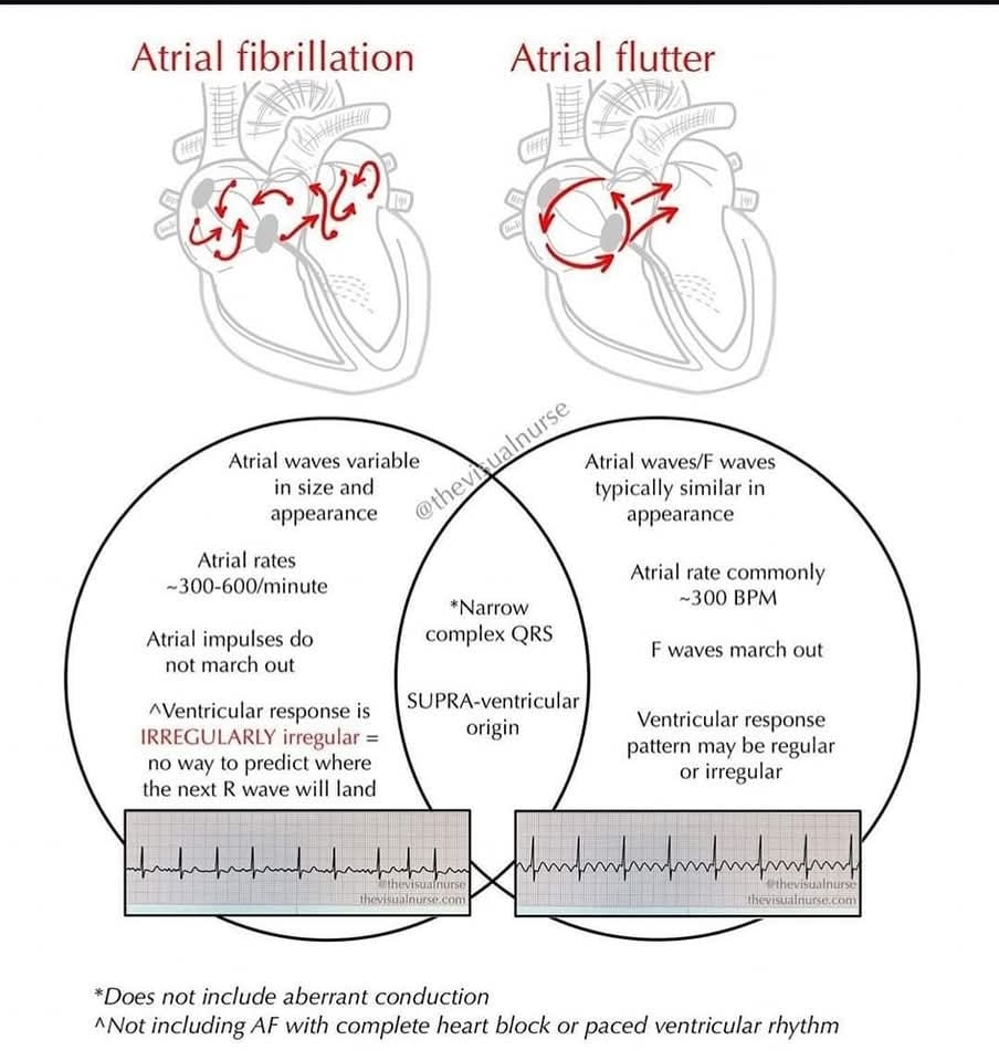 ZHeart11768530's tweet photo. 🔴Atrial fibrillation Vs. Atrial Flutter 🫀
#ecg #ekg #cardiology #ecginterpretation #electrocardiograma #electrocardiogram #nursing #cardiologista #healthy #interpretation #heart #nurse #hearts #heartbeat #ccu #cardio #cardiovascular #quiz #cardiologia #physicianassistant https://t.co/xFn4K9YoBn