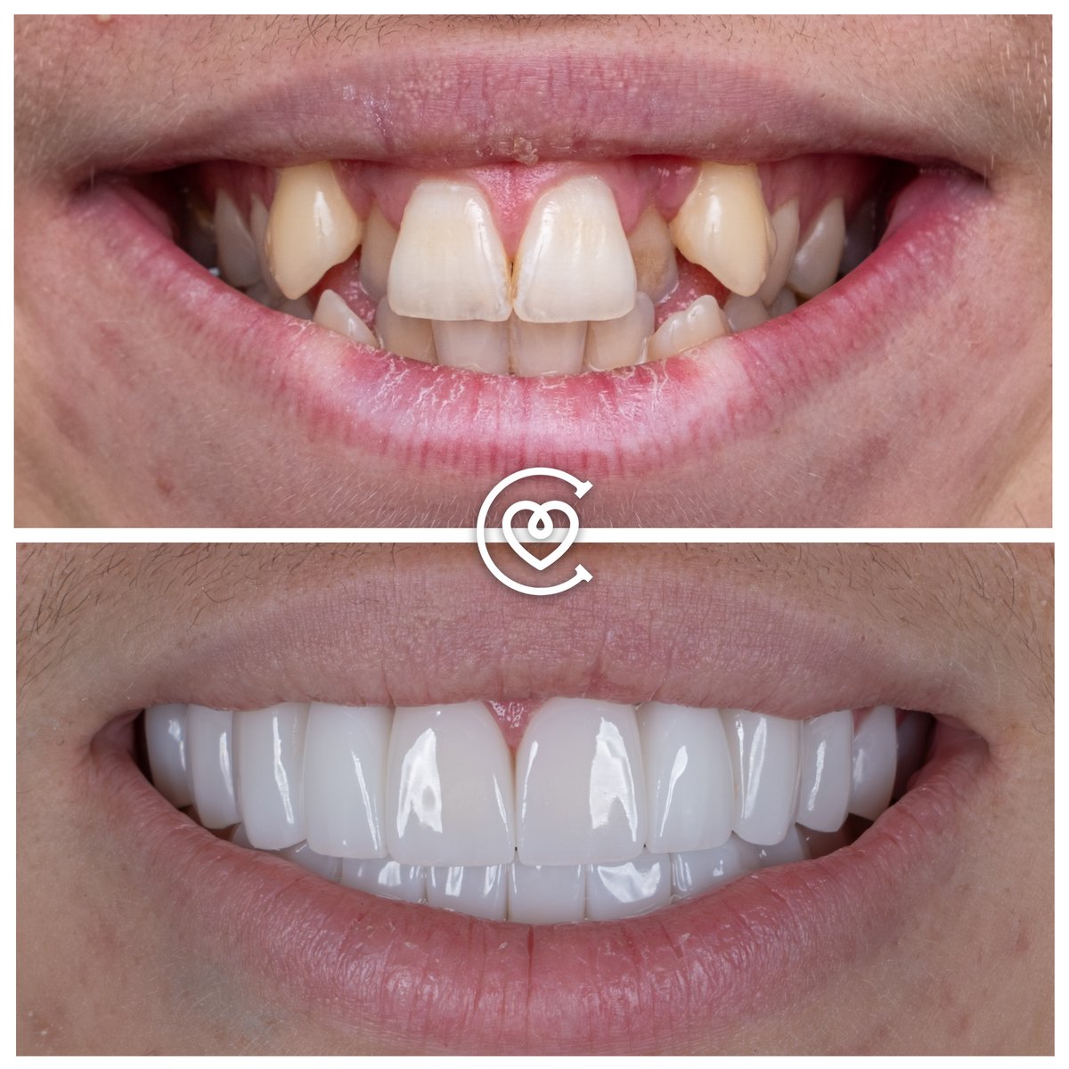 CayraClinic's tweet image. Missing teeth? 😔  Cayra Dental Clinic offers premium implants with a lifetime warranty! 😁  Expert implantologists, personalized care &amp;amp; stunning results. ✨  Contact us today! 📞 #dentalimplants #titaniumimplants #smilemakeover #antalya #turkey #cayradentalclinic #dentaltourism