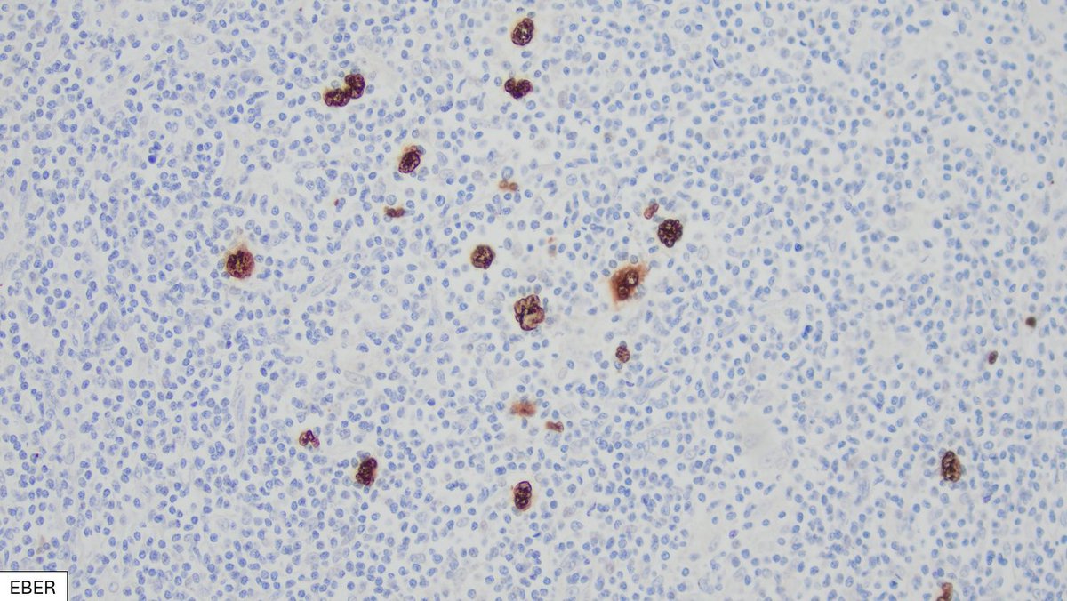 Example of mixed cellularity classic Hodgkin lymphoma (Figure 1) with an otherwise classic phenotype (Figure 2: CD30+ PAX5 dim+ CD45- CD79a-), but with increased B-cell marker expression (Figure 3: CD20+ BOB+ OCT2+) and EBER positvity (Figure 4), in the setting of immune