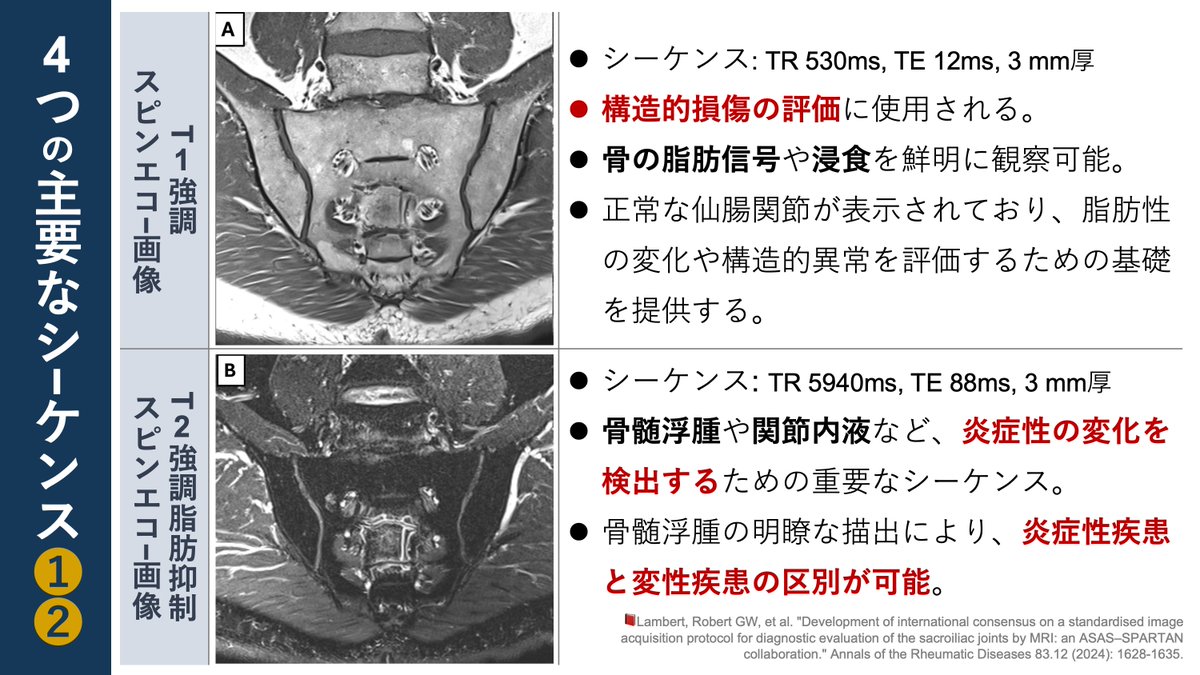 copellist's tweet image. 📕仙腸関節の画像評価
・脊椎関連学会所属の放射線科医13名, リウマチ専門医2名
・仙腸関節の標準化されたMRI画像取得プロトコルを開発
🔹評価の基準：S2椎体の背側皮質
🔹4つの主要なシ－ケンス(MRIのT1, T2)→様々な側面の評価
仙腸関節をMRI画像で評価することができるのですね😲
#仙腸関節 #MRI