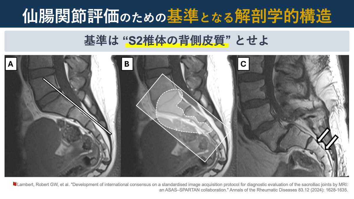 copellist's tweet image. 📕仙腸関節の画像評価
・脊椎関連学会所属の放射線科医13名, リウマチ専門医2名
・仙腸関節の標準化されたMRI画像取得プロトコルを開発
🔹評価の基準：S2椎体の背側皮質
🔹4つの主要なシ－ケンス(MRIのT1, T2)→様々な側面の評価
仙腸関節をMRI画像で評価することができるのですね😲
#仙腸関節 #MRI