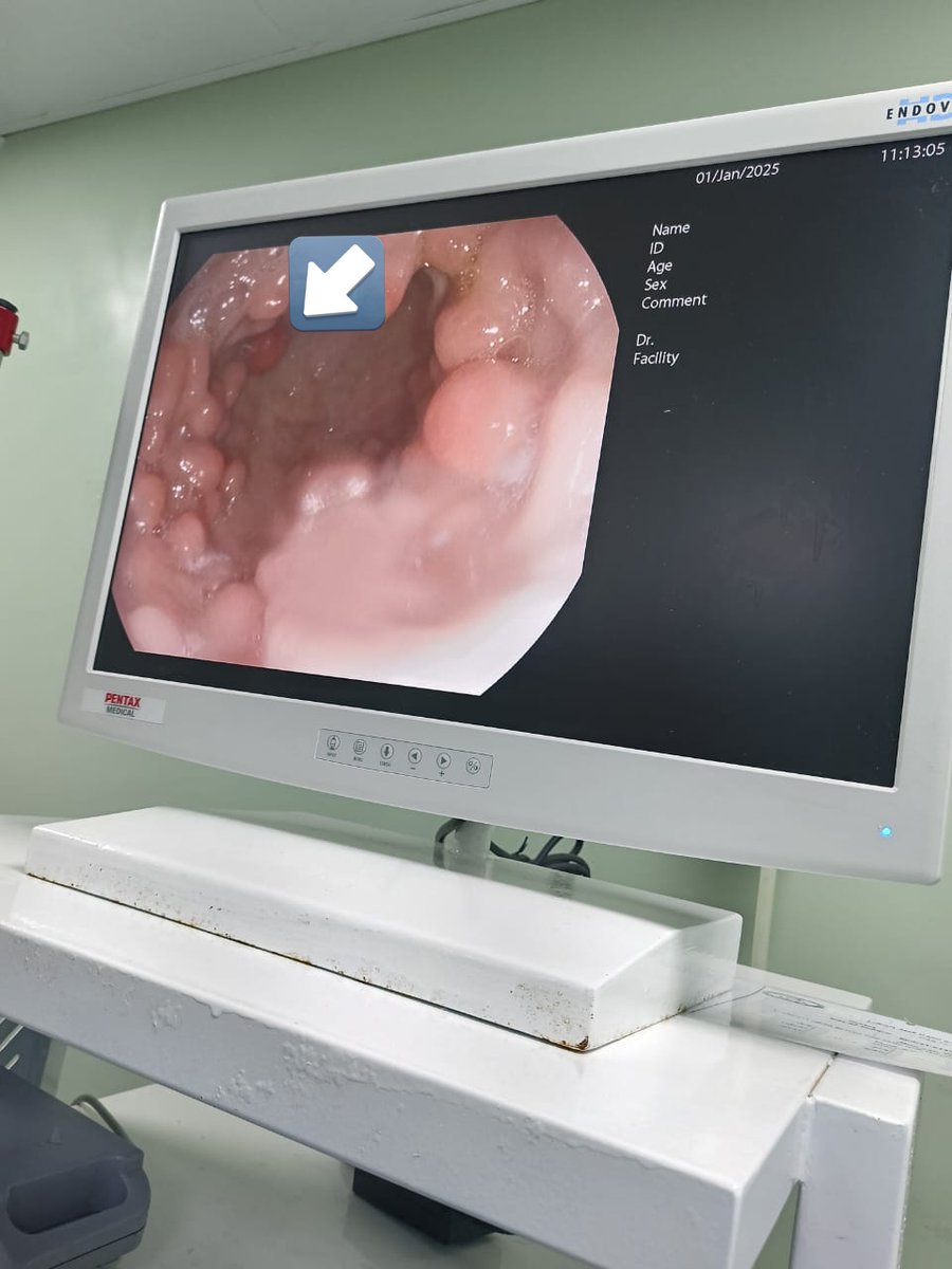 ShakerSky's tweet photo. Polypoidal form of GAVE (gastric antral vascular ectasia) with one polyp at 12 o'clock showing abnormal mucosal pattern. https://t.co/2ZbCTw4DXw