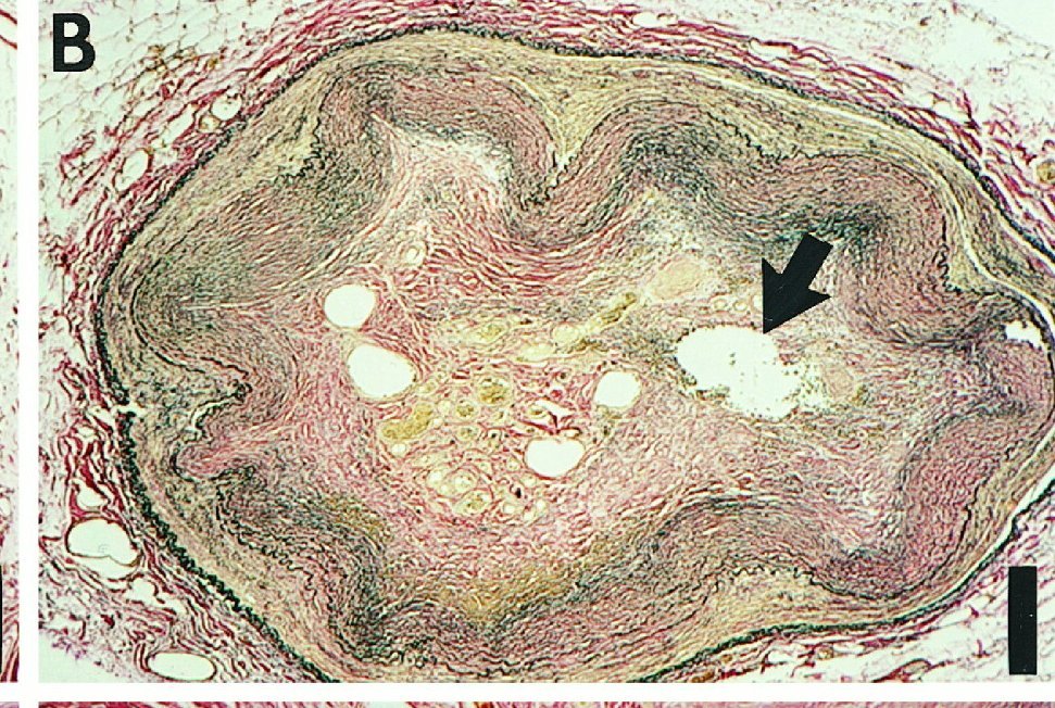 Ziad Ali (@ziadalinyc) on Twitter photo <a href="/SripalBangalore/">Sripal Bangalore</a> <a href="/realarainmd/">Salman Arain</a> Early after a CTO is formed macrophages penetrate the collagenizing granulation tissue (which is contracting) and create small cluster infiltrates. They eat the granulation tissue in circles, like a mini tordando, inside out. That's what these are. So <a href="/realarainmd/">Salman Arain</a> and <a href="/SripalBangalore/">Sripal Bangalore</a> <a href="/realarainmd/">Salman Arain</a> Early after a CTO is formed macrophages penetrate the collagenizing granulation tissue (which is contracting) and create small cluster infiltrates. They eat the granulation tissue in circles, like a mini tordando, inside out. That's what these are. So <a href="/realarainmd/">Salman Arain</a> and