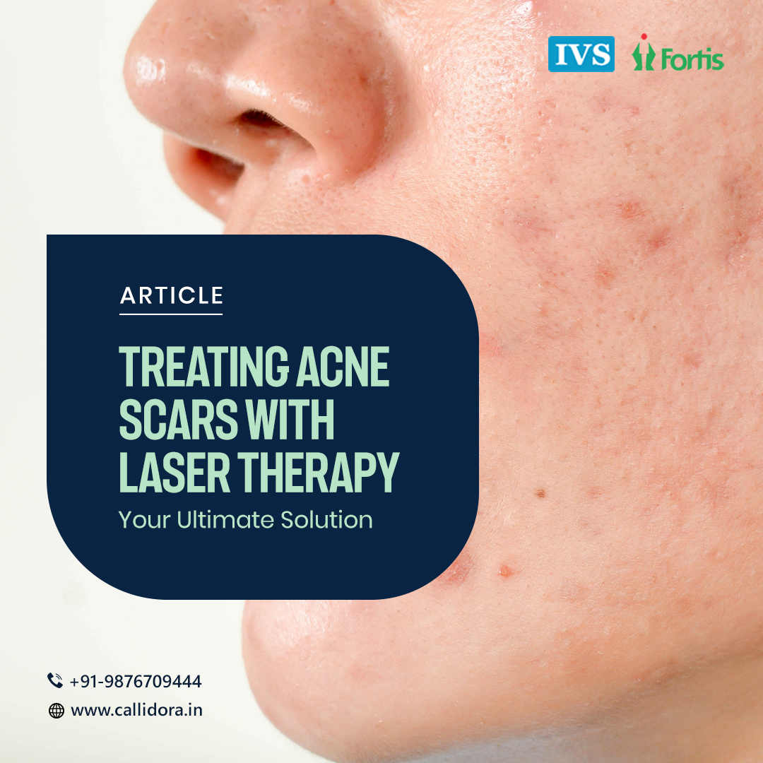 callidora_laser's tweet image. Laser therapy is a highly effective, non-invasive solution for treating acne scars and improving skin texture. Please read our full blog to summarize how it works and its benefits.
bit.ly/3ZZd6By
#Lasertherapy #noninvasivesolution #acne #scars #lasertreatment