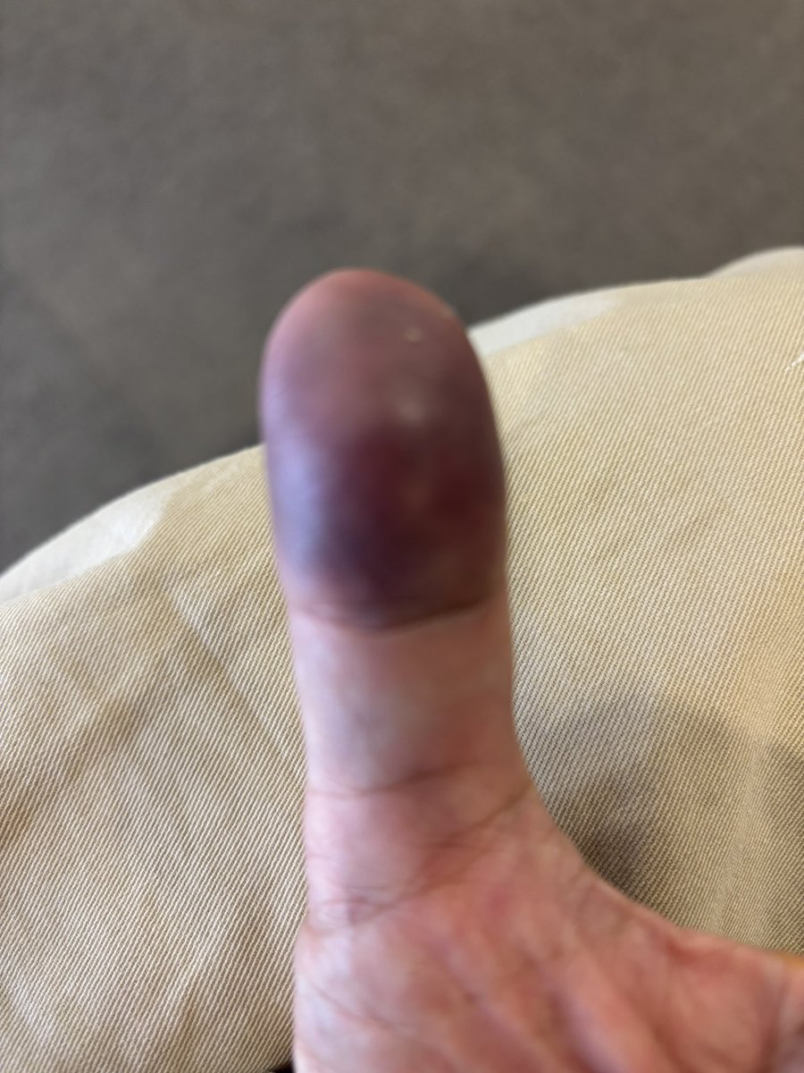 急患に行ったら、大きな骨折はなく、血を抜くまでもないそうで…良かった😅
紫色になってるのは、2週間は引かずそれから段々黄色になって行くだろうとの事💦意外とかかるのでビックリ🫢暫く痛みと仲良くする事にします💕

#RKBラジオ #内出血 #痛みとお付き合い