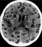 Escape2SEA's tweet photo. DON’T EAT UNDERCOOKED MEAT

Eating undercooked meat can lead to brain infections, including serious conditions like neurocysticercosis.

Read the Thread 👇