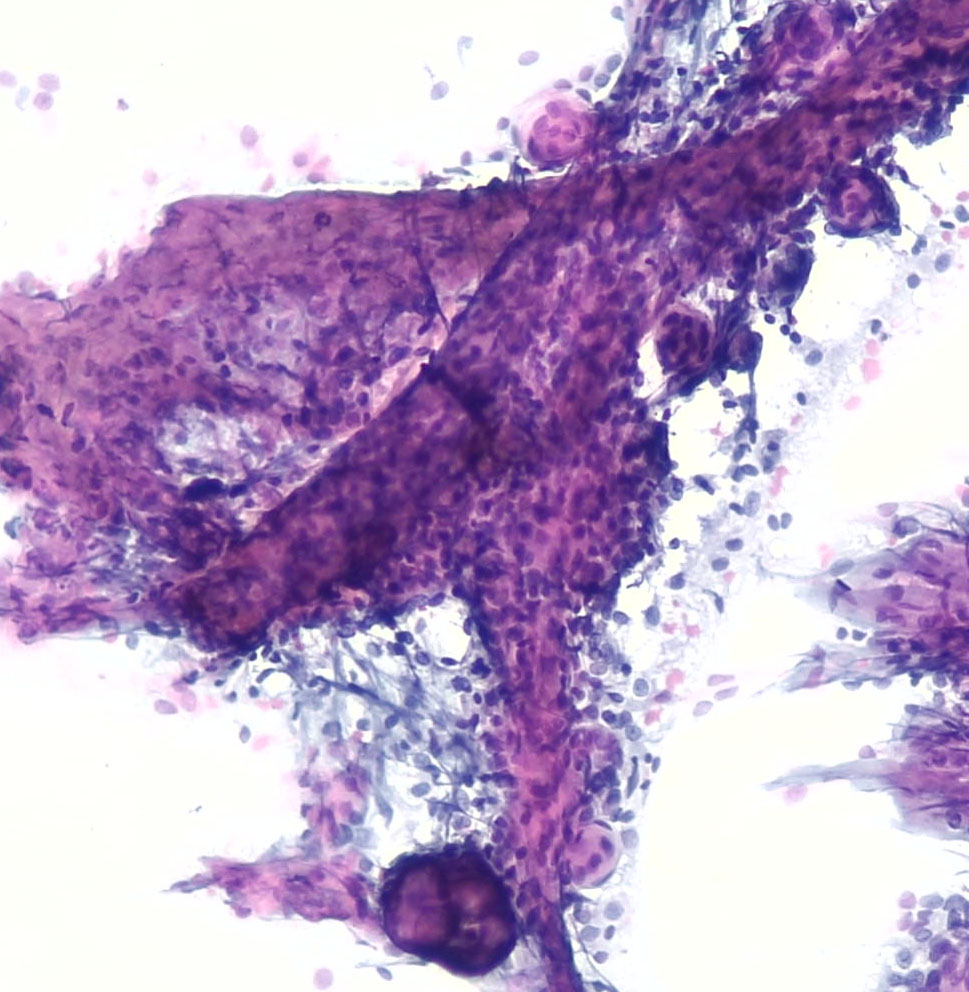 Lola Lozano (@mdlozanoe) on Twitter photo "Whorls all around"🌪️🌪️, a STUNNING example of a meningioma
And in addition:
Psammoma bodies,
Bland nuclei with some ICNI,
Fine and wispy cytoplasmic processes
<a href="/EfcsYoung/">Young EFCS</a> <a href="/IACytology/">International Academy Cytology</a> <a href="/cytopathology/">Cytopathology.org</a> <a href="/SECitologia/">Sociedad Española de Citología</a> #Cytopath "Whorls all around"🌪️🌪️, a STUNNING example of a meningioma
And in addition:
Psammoma bodies,
Bland nuclei with some ICNI,
Fine and wispy cytoplasmic processes
<a href="/EfcsYoung/">Young EFCS</a> <a href="/IACytology/">International Academy Cytology</a> <a href="/cytopathology/">Cytopathology.org</a> <a href="/SECitologia/">Sociedad Española de Citología</a> #Cytopath
