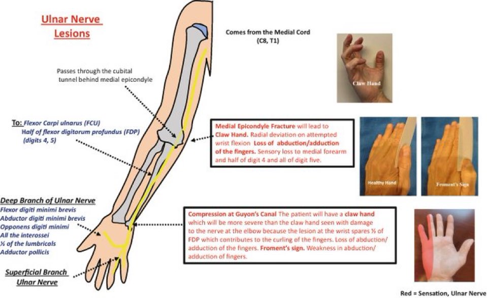 Omid_HopeUni's tweet image. Ulnar Nerve: innervations and injuries 

#nerve #neuropathy 

link.springer.com/book/10.1007/9…