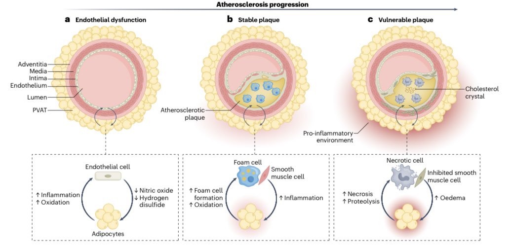 Leandro Slipczuk (@cardiomdphd) on Twitter photo Phenotyping atherosclerotic plaque and perivascular adipose tissue: signalling pathways and clinical biomarkers in atherosclerosis <a href="/damini_dey/">Damini Dey</a> <a href="/Piotr_JSlomka/">Piotr Slomka PhD</a> <a href="/imagingmedsci/">imagingmedsci</a> <a href="/danielbermanmd/">Daniel Berman</a> <a href="/DrAndrewLin/">Andrew Lin</a> <a href="/SmidtHeart/">Smidt Heart Institute at Cedars-Sinai</a> <a href="/MonteHeart/">Montefiore Heart</a> <a href="/NatRevCardiol/">Nature Reviews Cardiology</a> #ACCimaging
nature.com/articles/s4156… Phenotyping atherosclerotic plaque and perivascular adipose tissue: signalling pathways and clinical biomarkers in atherosclerosis <a href="/damini_dey/">Damini Dey</a> <a href="/Piotr_JSlomka/">Piotr Slomka PhD</a> <a href="/imagingmedsci/">imagingmedsci</a> <a href="/danielbermanmd/">Daniel Berman</a> <a href="/DrAndrewLin/">Andrew Lin</a> <a href="/SmidtHeart/">Smidt Heart Institute at Cedars-Sinai</a> <a href="/MonteHeart/">Montefiore Heart</a> <a href="/NatRevCardiol/">Nature Reviews Cardiology</a> #ACCimaging
nature.com/articles/s4156…