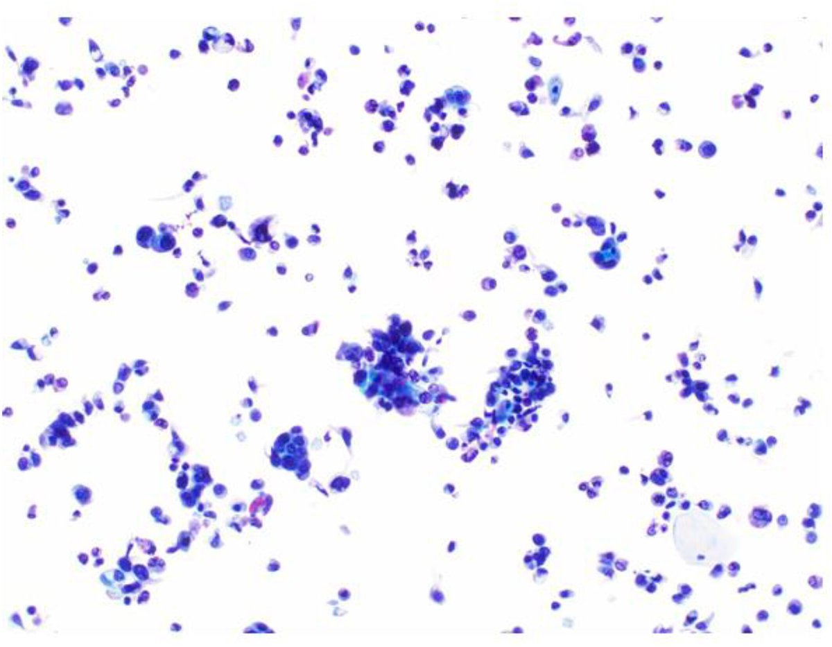 Cancer Cytopathology (@cancercytopath) on Twitter photo 🔬 A meticulous look at the quantitation criteria for diagnosing high-grade urothelial carcinoma in lower urinary tract specimens by <a href="/efohess/">Ola Folarin,MD</a> and @mtsidd.
acsjournals.onlinelibrary.wiley.com/doi/full/10.10…
#CytoPath 🔬 A meticulous look at the quantitation criteria for diagnosing high-grade urothelial carcinoma in lower urinary tract specimens by <a href="/efohess/">Ola Folarin,MD</a> and @mtsidd.
acsjournals.onlinelibrary.wiley.com/doi/full/10.10…
#CytoPath