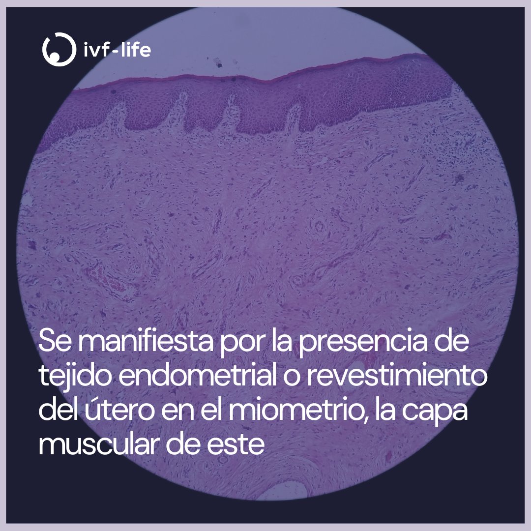 ivflife_'s tweet image. Esta enfermedad era conocida por estar relacionada con sangrados abundantes, fuertes dolores menstruales, así como con el aumento del tamaño del útero. 

Te contamos más en nuestro blog: bit.ly/4gEoBWa

#ivflife #fertilidad #ciencia #medicinareproductiva