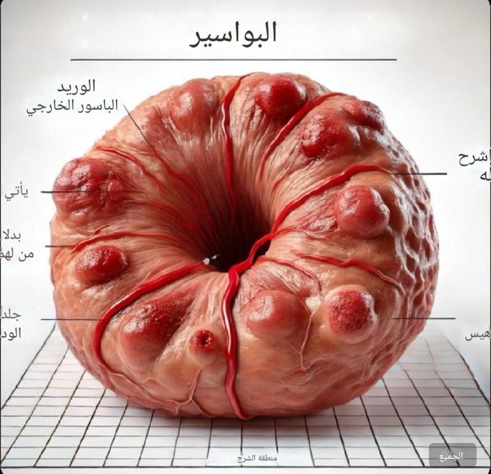 البواسير

رجل يجري عملية جراحية للبواسير ويتعهد بعدم أخذ هاتفه إلى المرحاض مرة أخرى.

اتضح أن جلسات التمرير التي لا تنتهي على المرحاض كانت أكبر خطأ ارتكبه. لكن قصته لا تنتهي.

في هذا الموضوع، نتعلم ما الذي يسبب البواسير حقًا، والأهم من ذلك، كيفية تجنبها.

تعال معي 👇