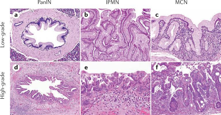 thejourneymate's tweet photo. Histology of the Precursor Lesions for Sporadic Pancreatic Cancers🔬
https://t.co/SaFFd3YwvO https://t.co/Ycl4ep2NFh
