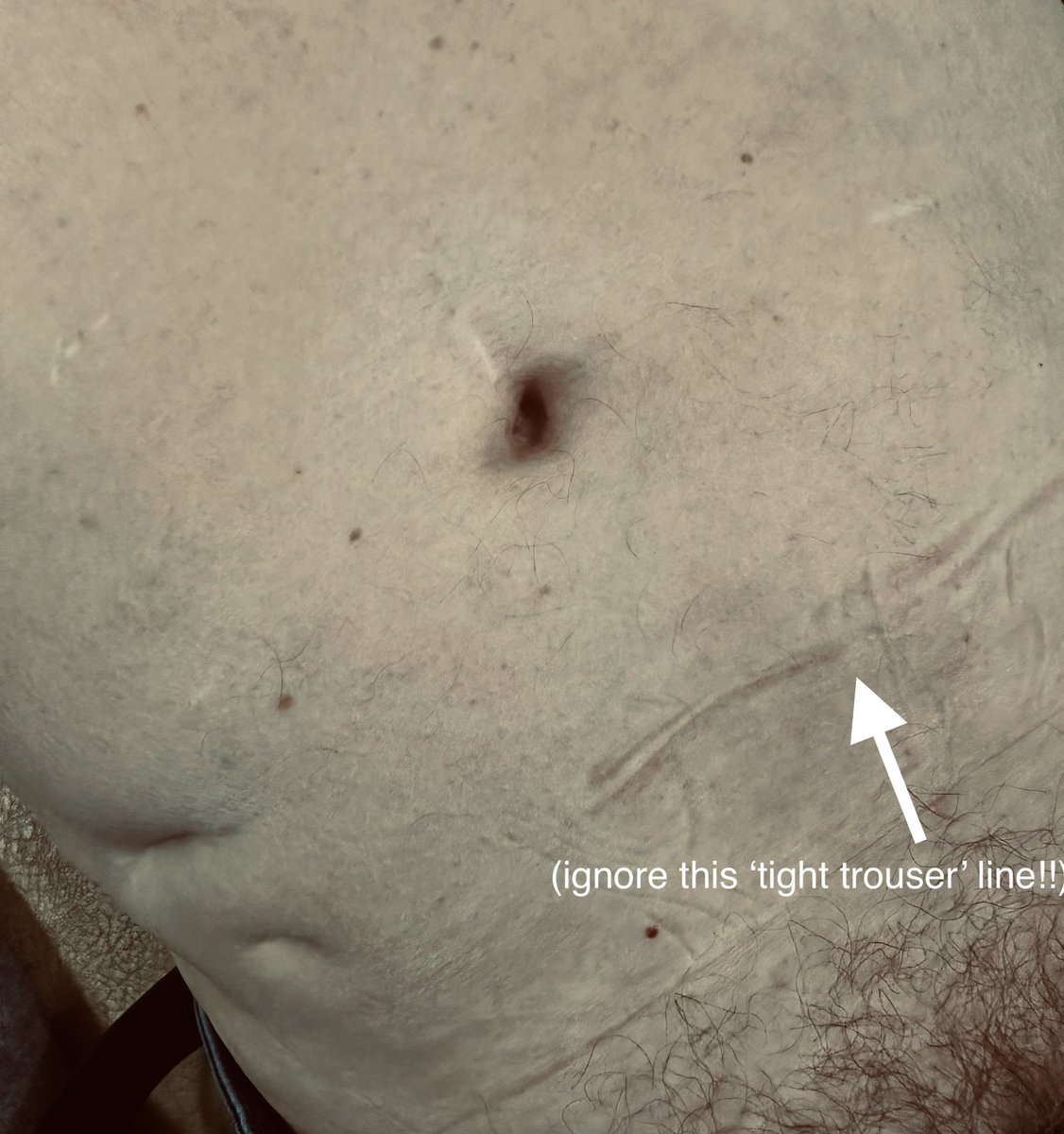 DrJN_SportsMed's tweet image. Documented consent ✅✅

Super fit male 70s

Extreme skiing, climbing 

Previous lumbar fusion, then discectomy L4/5

Lost sporting confidence, with insidious drop off in functional power &amp;amp; coordination in R &amp;gt; L legs

Dragging foot

Leg doesn’t “feel like my own &amp;amp; it spasms…