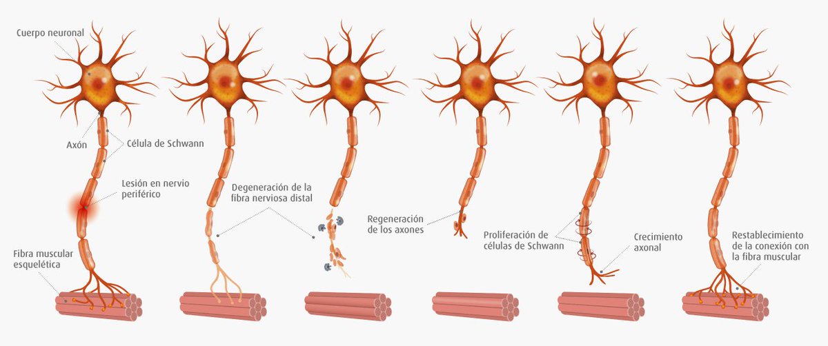 Busco neurólogo/a que sepa de neuropatía periférica. Tras meses de tratamientos contra varios tumores sufro neuropatía en manos y pies, perdiendo movilidad fina y con dolor. Soy bueno investigando y buscando soluciones. Necesito asesoría en el tema... ¿algún experto? Gracias 🫂
