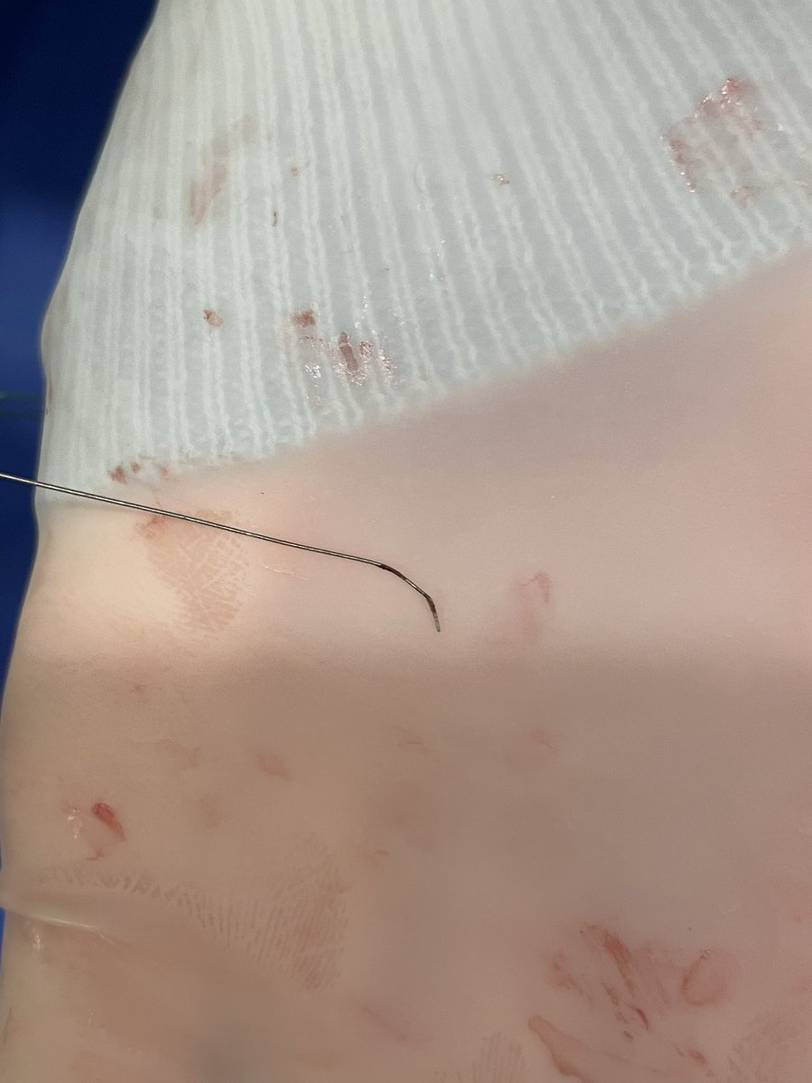 LAzzaliniMD's tweet photo. First case of 2025: charred Astato and split microcatheter tip. 😮
What a year ahead…
#ECART #CTO https://t.co/ZtufjYmkoS