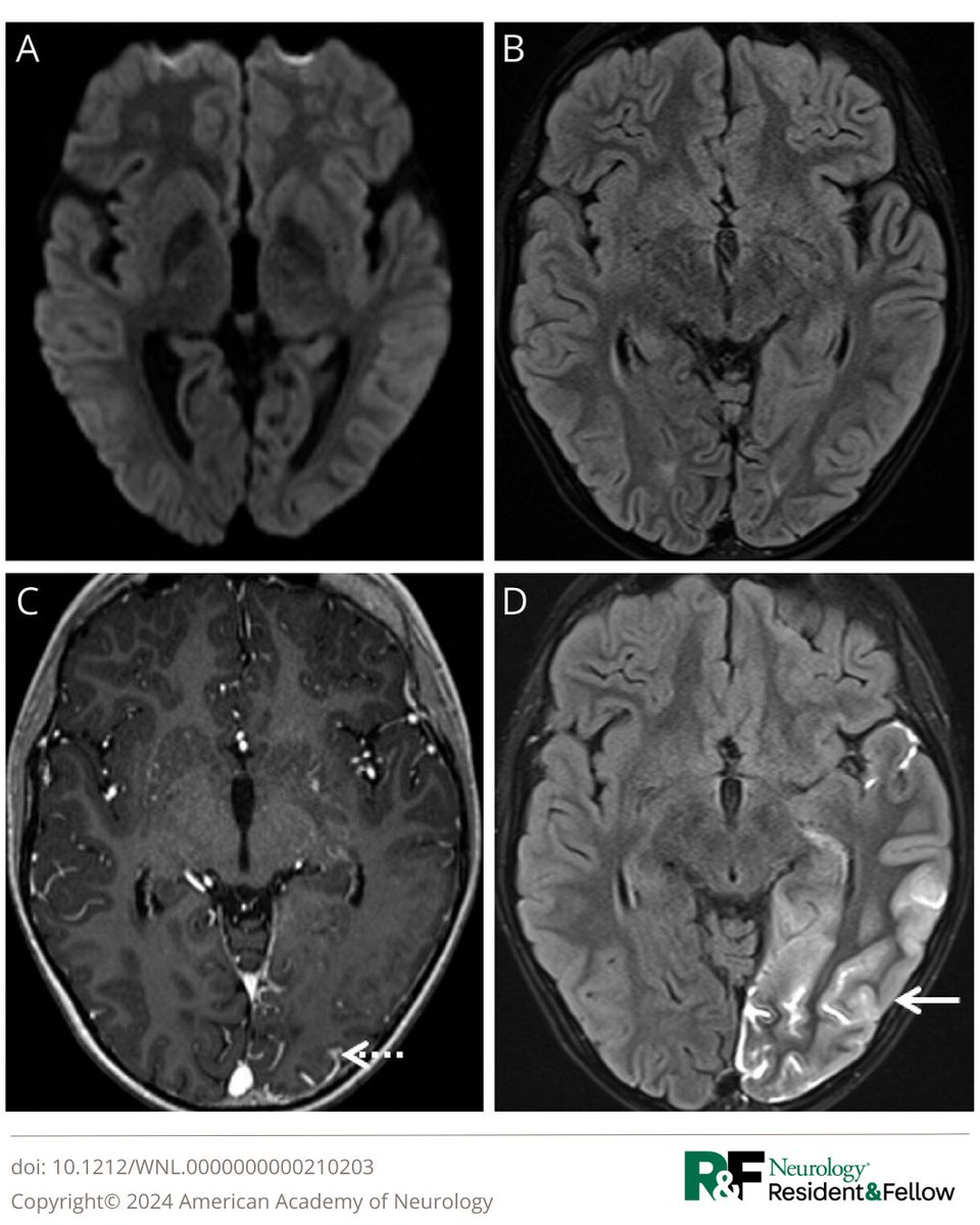 Teaching NeuroImage: Stroke-Like Migraine Attacks After Radiation Therapy Syndrome bit.ly/4iB3q93 

#NeurologyRF