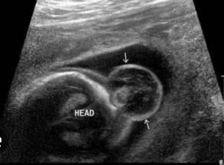 deepti_bahl's tweet photo. What is the antenatal Usg finding shown in the image below ? #MedTwitter #obgyn https://t.co/1USUMXWmg8