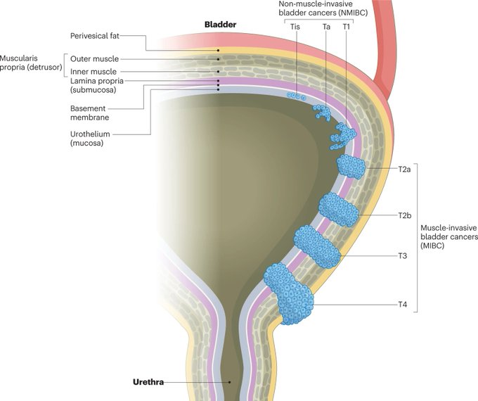 Enrique Grande (@drenriquegrande) on Twitter photo ⚡️ Global trends in the epidemiology of bladder cancer: challenges for public health and clinical practice
#BladderCancer <a href="/NatRevClinOncol/">NatureRevClinOncol</a>
nature.com/articles/s4157… ⚡️ Global trends in the epidemiology of bladder cancer: challenges for public health and clinical practice
#BladderCancer <a href="/NatRevClinOncol/">NatureRevClinOncol</a>
nature.com/articles/s4157…
