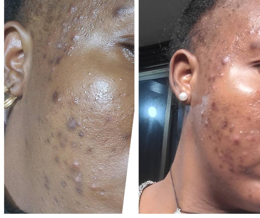 Dashalucky6's tweet image. Our day 5 of treatment. @Dashalucky6
#SKINSPIRED #skincare #skinroutine