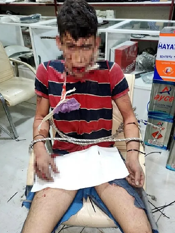 haskologlu's tweet photo. Antalya'da 22 yaşındaki Vedat Kurt, 3 gün boyunca:

• Depoya kilitlendi,
• Dişleri söküldü ve kırıldı,
• Ağzına zorla hamam böceği sokup yedirildi, 
• Dikenli tellerle zincire bağlandı.

Vedat Kurt'a günlerce bu işkenceyi yapan şahıslar serbest bırakıldı. https://t.co/321GXIg5ao