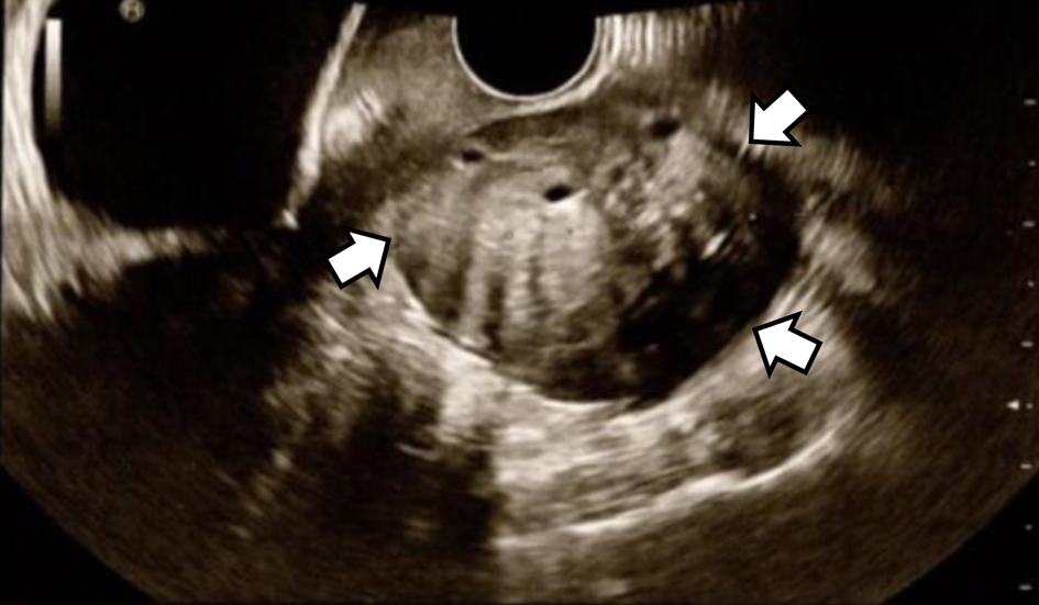 #OvarianCellularFibroma: Magnetic Resonance Imaging Findings With Pathological Correlation
jcgo.org/index.php/jcgo…