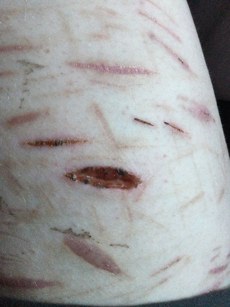 tism_eater's tweet photo. Honestly I’m not surprised this cut is having issues healing 😭😭

Its looked like this for about two days 😓😓
Deep beans/ fascia 
#shtwt #slitwt #fasica #laffytaffytwt
All fake spx https://t.co/GEST1niYh1