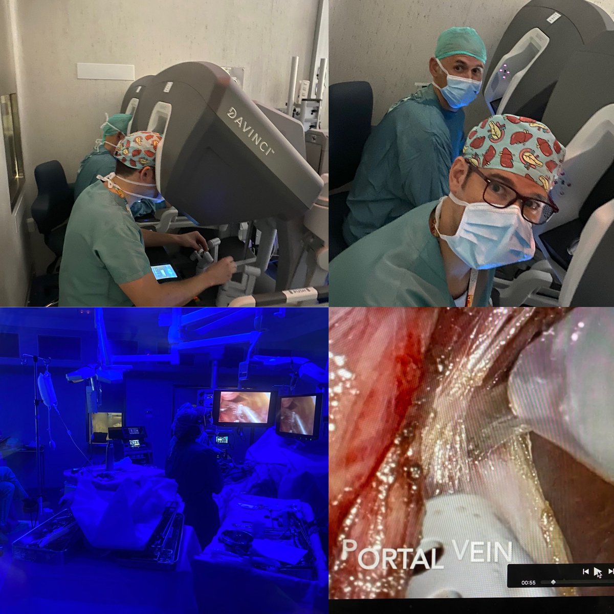 HPBcrti (@hpbcrti) on Twitter photo Hoy en <a href="/hgermanstrias/">Hosp. Germans Trias</a> <a href="/HPBcrti/">HPBcrti</a> iniciamos la #cirugiarobotica con doble consola <a href="/abexDaVinci/">ABEX Excelencia Robótica</a> en reseccion #hpb. Mejor visión: mejor colaboración: mejor progresión! Hoy en <a href="/hgermanstrias/">Hosp. Germans Trias</a> <a href="/HPBcrti/">HPBcrti</a> iniciamos la #cirugiarobotica con doble consola <a href="/abexDaVinci/">ABEX Excelencia Robótica</a> en reseccion #hpb. Mejor visión: mejor colaboración: mejor progresión!