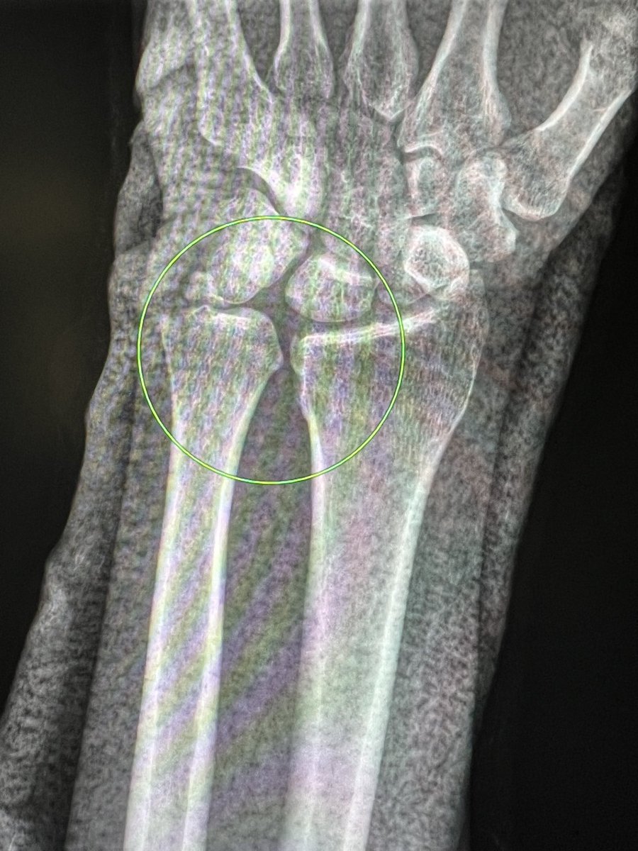 samrad77's tweet photo. Distal radioulnar joint dislocation on radiographs: 

1. AP view: Widened distal radioulnar joint. Ulnar styloid avulsion. Positive ulnar variance (always!). Simultaneous fracture of the radius. 

2. Lateral view (pitfall: true lateral must)- Dorsal dislocation/subluxation

—Trauma radiographs: pearls and pitfalls