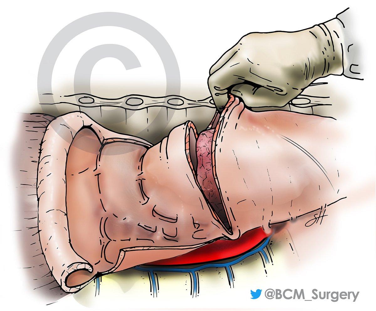 R. Taylor Ripley, M.D. Thoracic Surgeon (@rtaylorripley) on Twitter photo Actively enrolling in NEMO for patients with #mesothelioma in which patients receive three cycles of immunotherapy or chemoimmunotherapy followed by surgery followed by one year of immunotherapy
<a href="/BCM_Surgery/">BCM_Surgery</a> <a href="/bcmhouston/">BCMHouston</a> <a href="/BCMCancerCenter/">Dan L Duncan Comprehensive Cancer Center</a> <a href="/BCMFromtheLabs/">From the Labs at Baylor College of Medicine</a> 713-798–LUNG (6376). Actively enrolling in NEMO for patients with #mesothelioma in which patients receive three cycles of immunotherapy or chemoimmunotherapy followed by surgery followed by one year of immunotherapy
<a href="/BCM_Surgery/">BCM_Surgery</a> <a href="/bcmhouston/">BCMHouston</a> <a href="/BCMCancerCenter/">Dan L Duncan Comprehensive Cancer Center</a> <a href="/BCMFromtheLabs/">From the Labs at Baylor College of Medicine</a> 713-798–LUNG (6376).