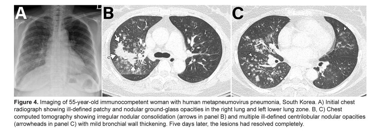 Human Metapneumovirus - A known entity
- Discovered in 2001 as a causative agent of respiratory infections in children 
- Non segmented (-) SS RNA
- Can cause severe infections in older adults (&gt;65 years old), current smokers and immunocompromised individuals
-  CT findings