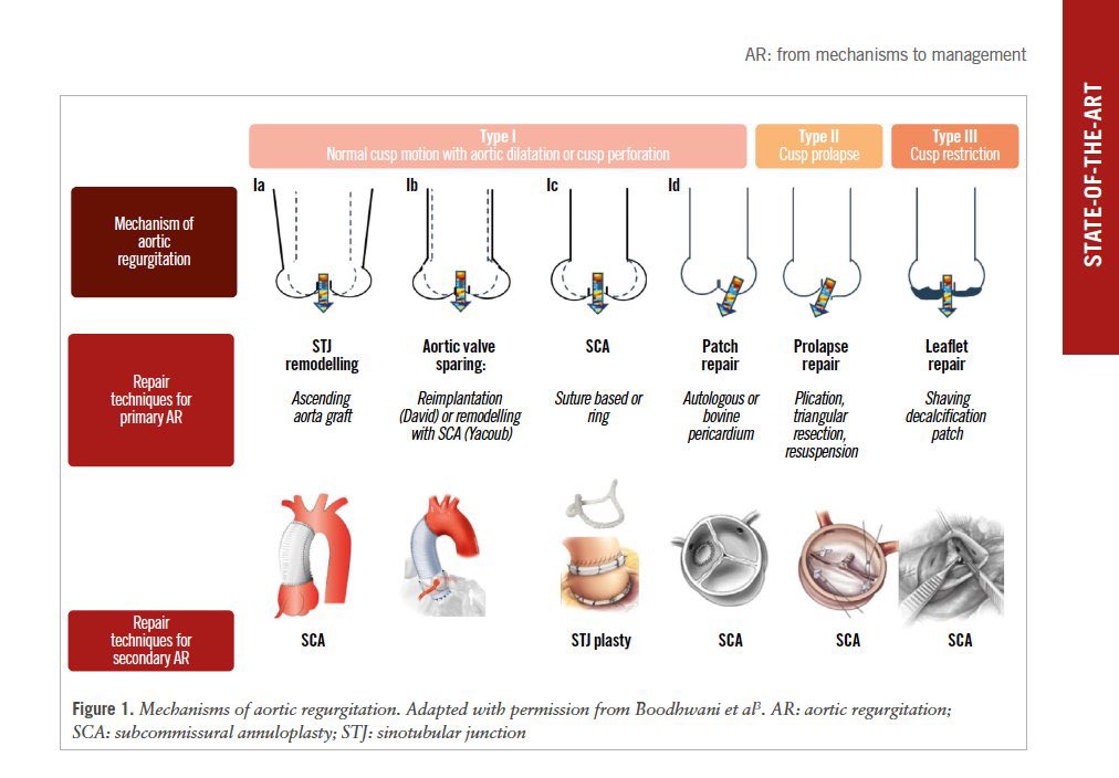 Edgardo Alania (@ed_alania) on Twitter photo 🔴 Aortic regurgitation: from mechanisms to management <a href="/EuroInterventio/">EuroIntervention</a> #Cardiology #CardioEd #CardioMed 🔴 Aortic regurgitation: from mechanisms to management <a href="/EuroInterventio/">EuroIntervention</a> #Cardiology #CardioEd #CardioMed