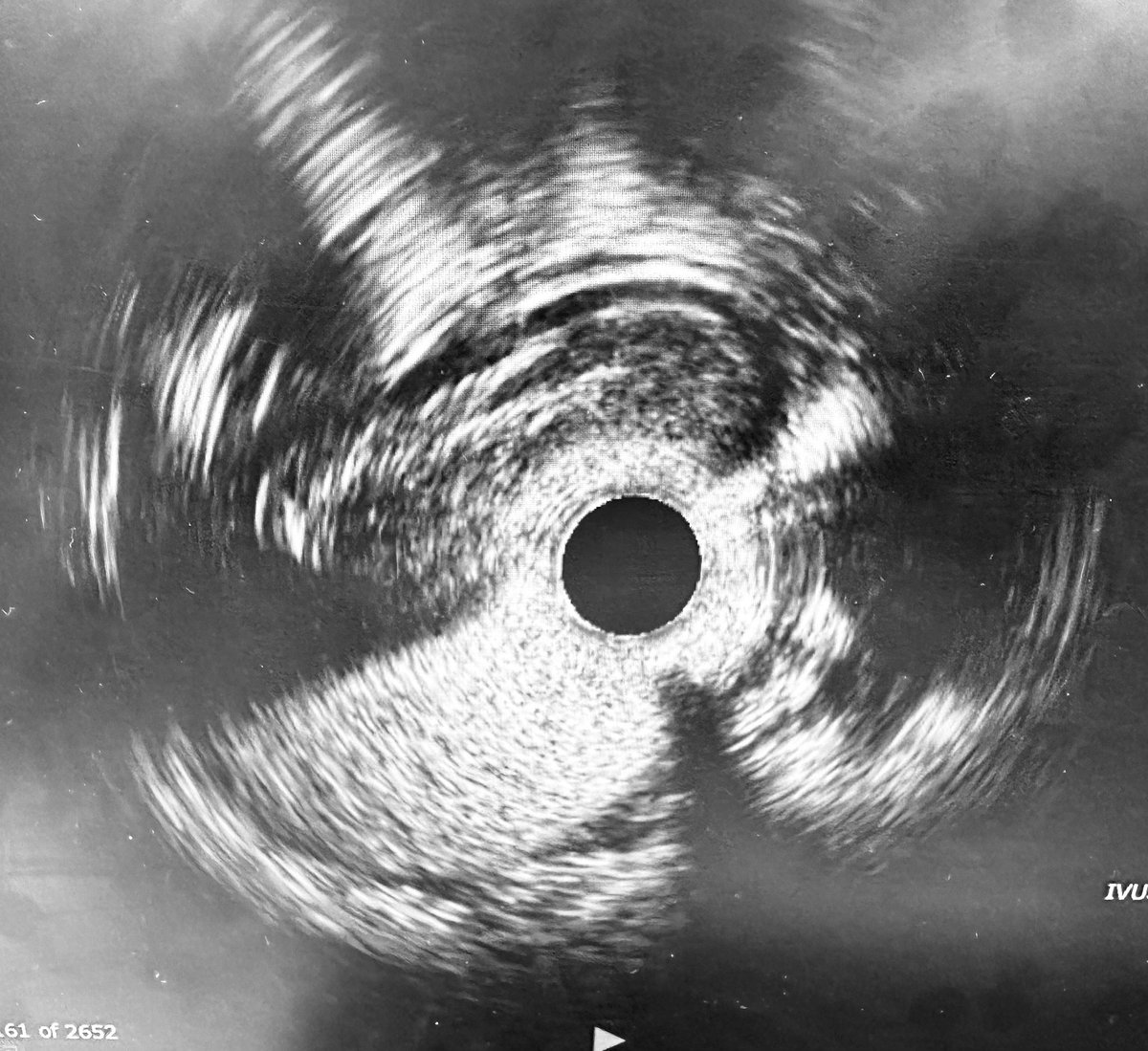 1/2 Ostial-thru-mid RCA calcified 🪨CTO: referred to our Team after prior failed attempts. Started Retro surfing 🏄‍♂️ but no suitable Septals (primarily telephone 📞 cord epicardial collaterals). Pivoted to AWE. Got subintimal purchase with P200👍…