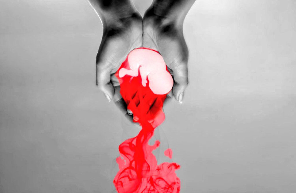 SiateSanti's tweet photo. 🚼🚮 2024:
L' #aborto è stata la principale causa di
morte a livello globale con un record di 45 milioni di bambini non ancora nati uccisi nell'utero, secondo i dati forniti da #Worldometer.
A mezzogiorno del 31 dicembre 2024:
▪︎ 45,1 milioni di aborti nel corso dell'anno.
▪︎ 8,2 milioni di persone sono morte di #cancro.
▪︎ 5 milioni di fumo.
▪︎ 1,7 milioni di #HIV.
▪︎ 1,35 milioni per incidenti stradali
▪︎ 1,1 milioni per suicidi0.
