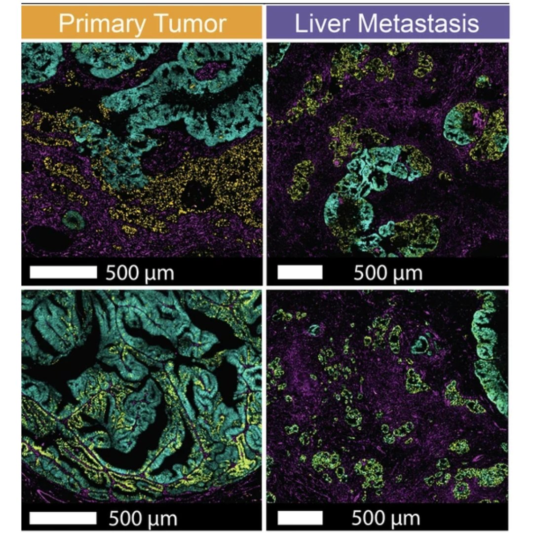 Damon Runyon Cancer Research Foundation (@damonrunyon) on Twitter photo Metastasis accounts for most cancer deaths. A new study from Damon Runyon alum <a href="/KarunaMDPhD/">Karuna Ganesh</a> reveals why metastatic tumors are so much harder to treat than primary tumors—and how the process of metastasis may be curbed. Read more: bit.ly/4iW0fZz Metastasis accounts for most cancer deaths. A new study from Damon Runyon alum <a href="/KarunaMDPhD/">Karuna Ganesh</a> reveals why metastatic tumors are so much harder to treat than primary tumors—and how the process of metastasis may be curbed. Read more: bit.ly/4iW0fZz