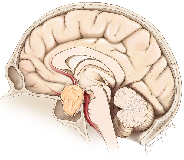 neurosurgatlas's tweet photo. Adherent tumor capsule often engulfs the small and medium size arteries at the skull base and is refractory to total excision. In such cases, which additional method should also be considered? #SkullBaseSurgery #TumorExcision #MedicalInnovation #SurgicalChallenges https://t.co/Uc4QCREM5g