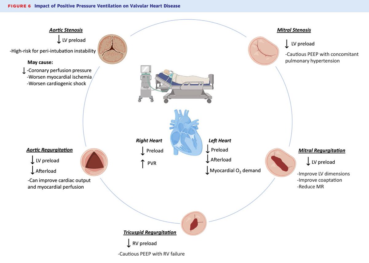 Ankeet S. Bhatt, MD, MBA (@ankeetbhatt) on Twitter photo Excellent SOTA review in <a href="/JACCJournals/">JACC Journals</a> #JACCAdv led by <a href="/ElliottMillerMD/">Elliott Miller</a> on contemporary evaluation & management of decompensated #valve disease in the #CICU.🗝️ figures essential for all CV #FITs with an interest in critical care cardiology! <a href="/BalimSenmanMD/">BalimSenman</a> <a href="/AnnGageMD/">Ann Gage</a> <a href="/venumenon10/">venu menon</a> Excellent SOTA review in <a href="/JACCJournals/">JACC Journals</a> #JACCAdv led by <a href="/ElliottMillerMD/">Elliott Miller</a> on contemporary evaluation & management of decompensated #valve disease in the #CICU.🗝️ figures essential for all CV #FITs with an interest in critical care cardiology! <a href="/BalimSenmanMD/">BalimSenman</a> <a href="/AnnGageMD/">Ann Gage</a> <a href="/venumenon10/">venu menon</a>