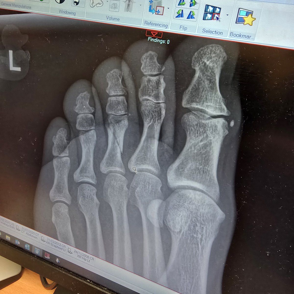 39 year old male. F+W. No meds. High speed collision with a shin. Forced toe abduction. Immediate pain. Unable to toe off. Swelling within 30 mins and potential depression site proximal phalanx. Xray confirmed fracture.  

The burning Question......... to NSAID or not to NSAID.
