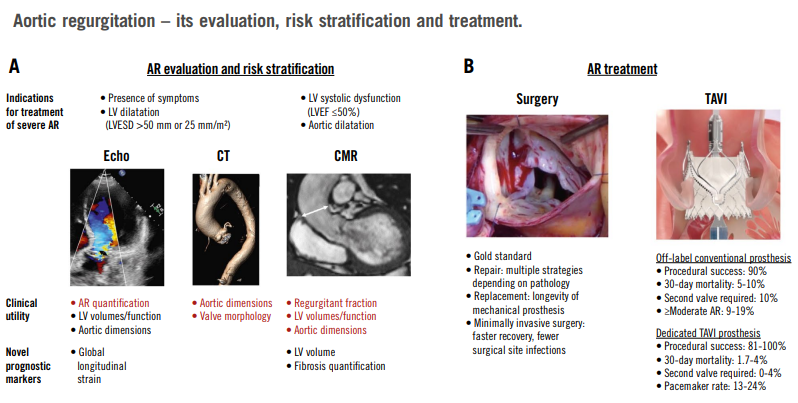 🆕 Insuficiencia aórtica: Mecanismos, diagnóstico, tratamiento. Revisión exhaustiva y actualizada.

📕 EuroIntervention
🔓 Resumen del artículo en cardioteca.com/cardiologia-cl…